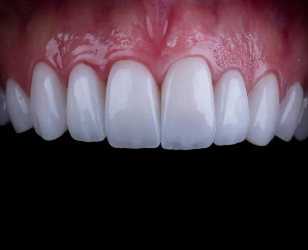 Resin veneers before and after smile result